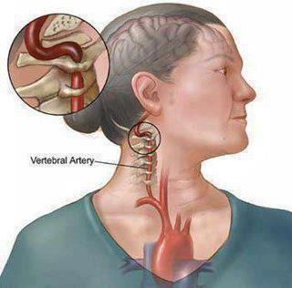 الجلطة الدماغية