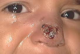 تازة تسجل 52 حالة من الليشمانيا خلال الخمسة أشهر الأولى من 2013