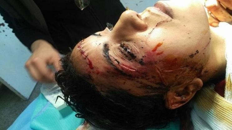 فاس: حمل زوجته مسؤولية ولادة بنت عمياء فعنفها و “شرمل” وجهها